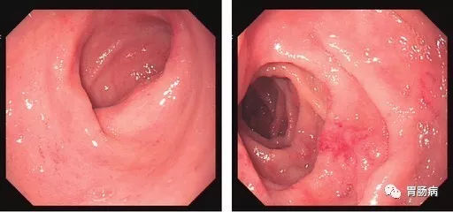 萎縮性胃炎不可怕，只要真正了解它