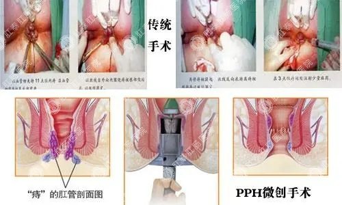 南寧肛門(mén)息肉手術(shù)要多少錢(qián)