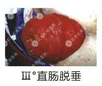 南寧肛門(mén)息肉手術(shù)要多少錢(qián)