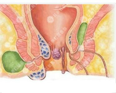 南寧哪個醫(yī)院可以做肛周膿腫？
